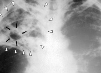 radiografía de tuberculosis muy avanzada