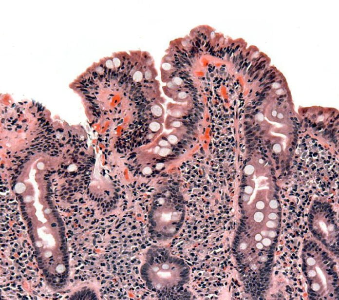Imagen de biopsia de intestino delgado afectado de celiaquía