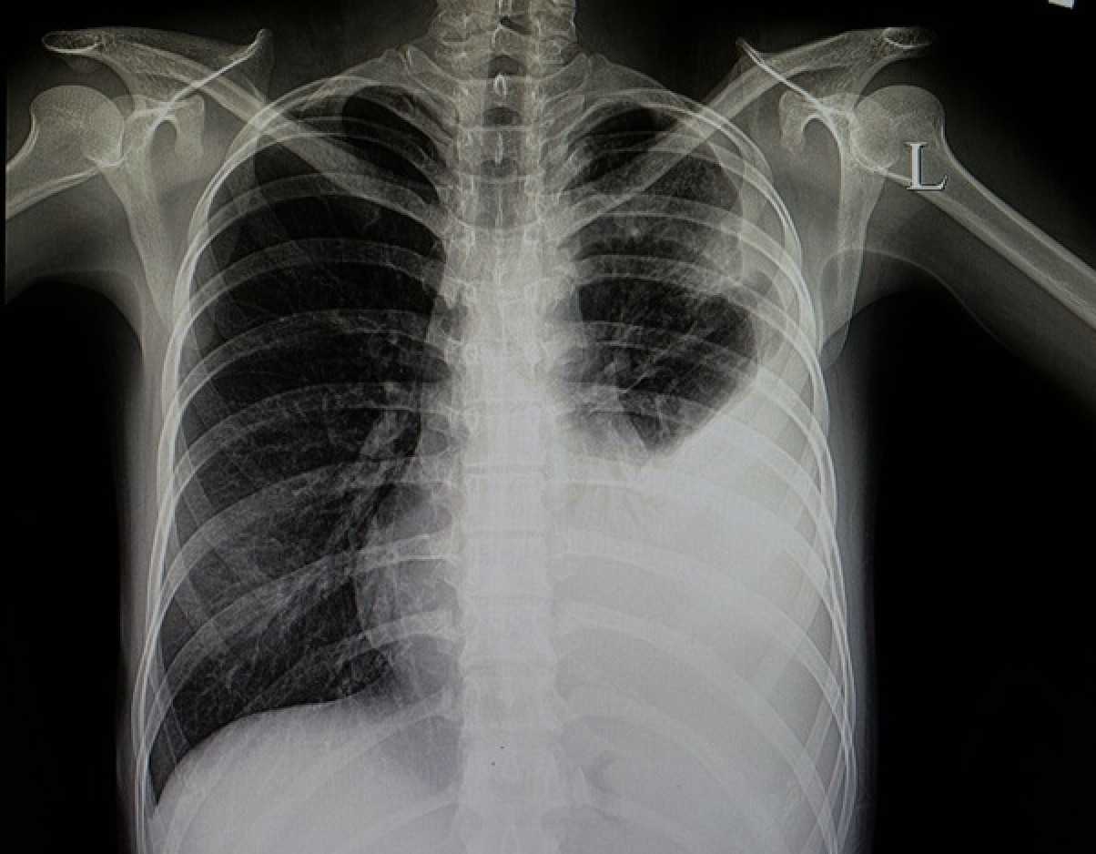 Neumonía: Imagen de Radiografía torácica